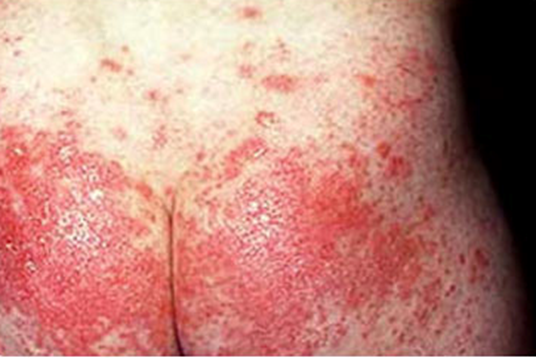 Scarlet Fever: A Group A Streptococcal Infection ...