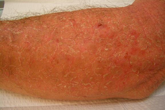 Eczema 2.jpg