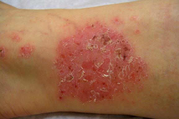Eczema 1.jpg