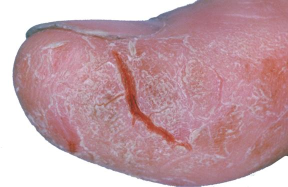 Hand Eczema 3.jpg
