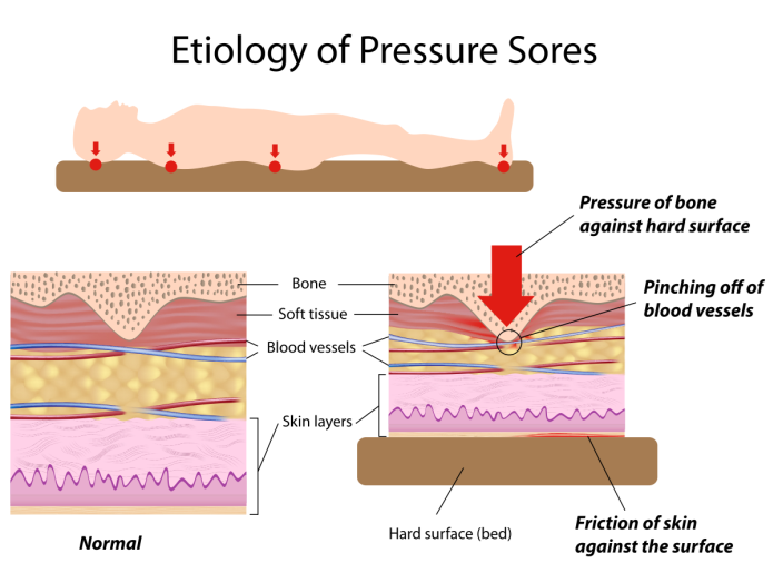 https://www.randyjacobsmd.com/patient-education/pressure-sores_files/image003.png